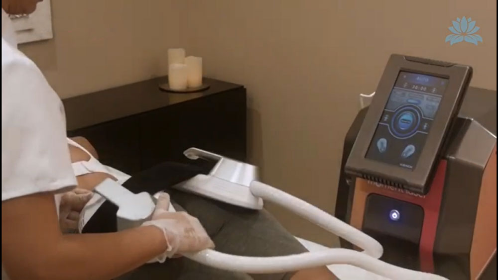 Sculpt Belight - Impulsos Eletromagnéticos SCULPT Nadegas 1