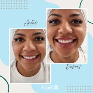 Case de Sucesso - Preenchimento com Ácido Hialurónico (1ml)