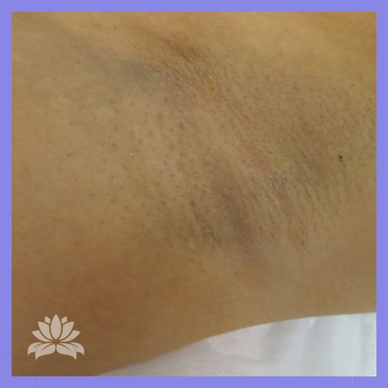 caso 22 epilacao triplo laser 2