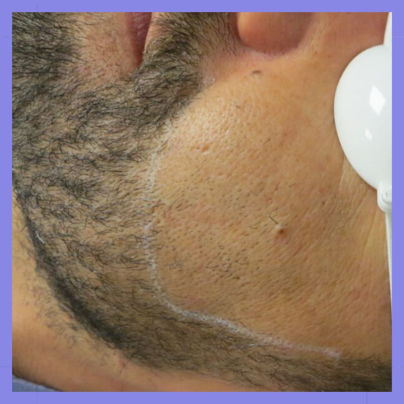 laser barba depois 2