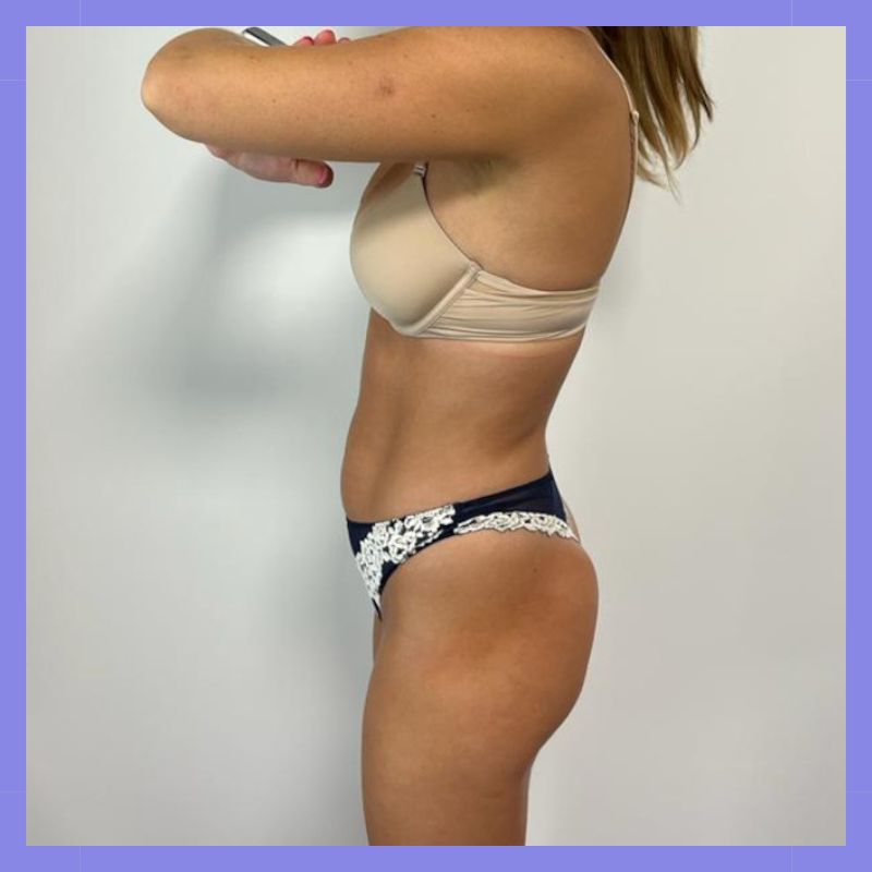 caso 147 antes e depois x wave belight 10