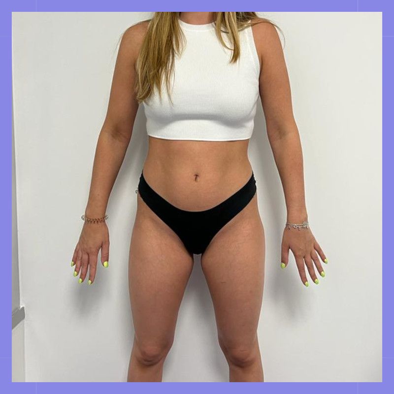 caso 147 antes e depois x wave belight 11