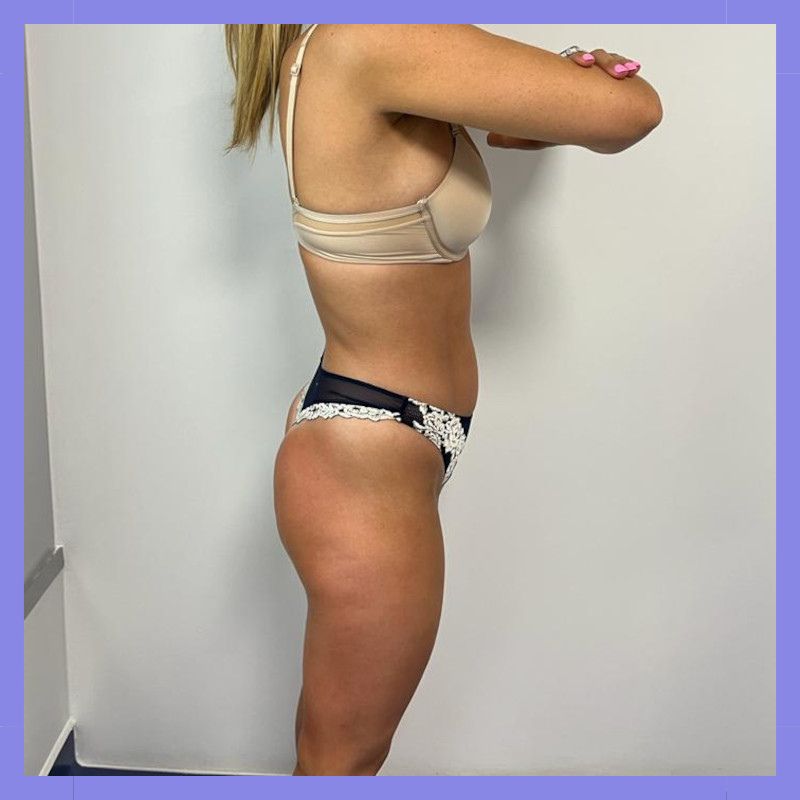 caso 147 antes e depois x wave belight 14