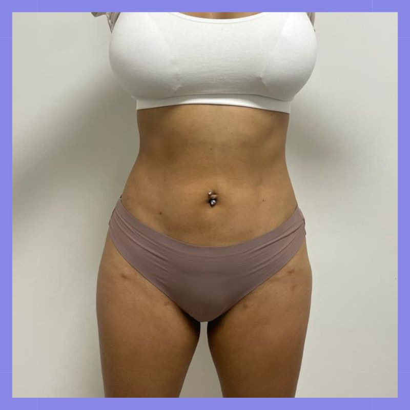 caso 23 exilis bl 6