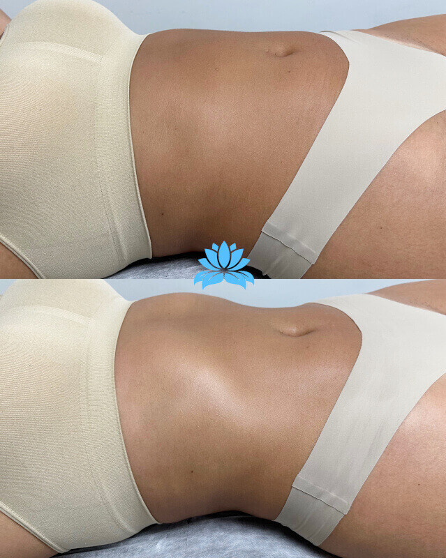 belight dlm antes depois 2