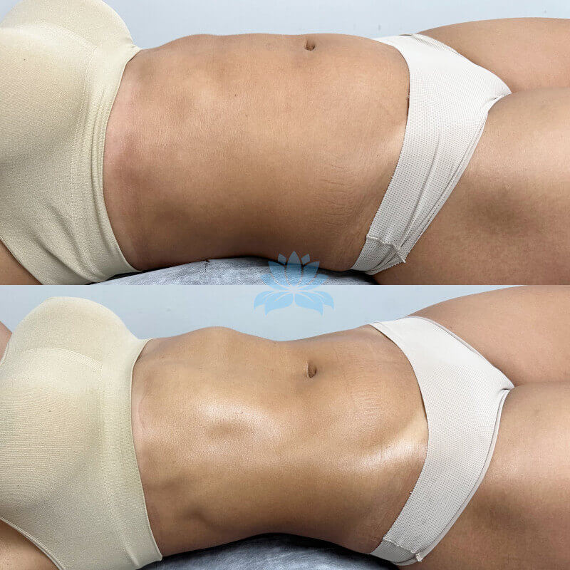 belight dlm antes depois