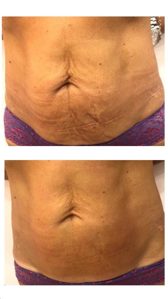 hifu antes e depois caso 4 1