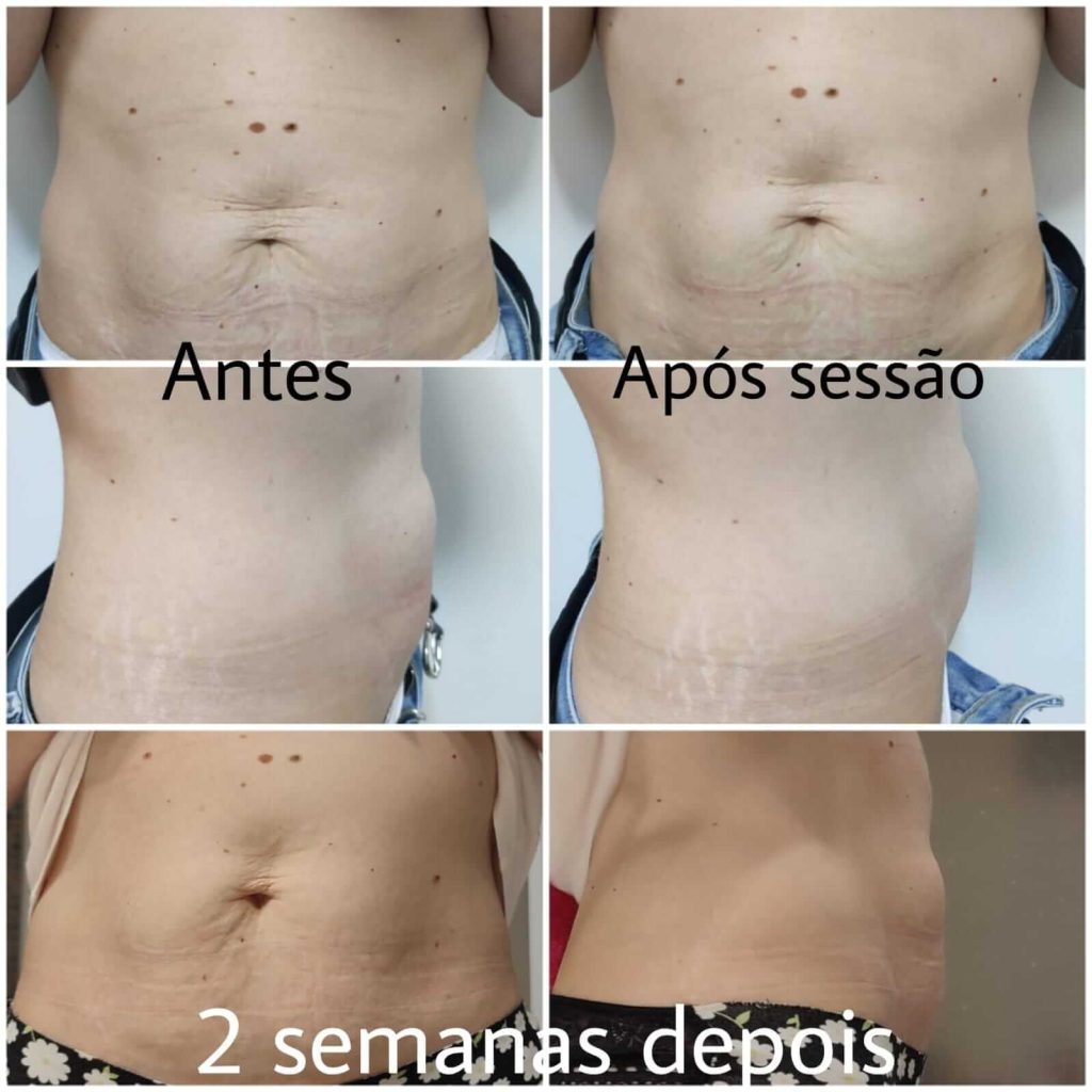 hifu antes e depois caso 5