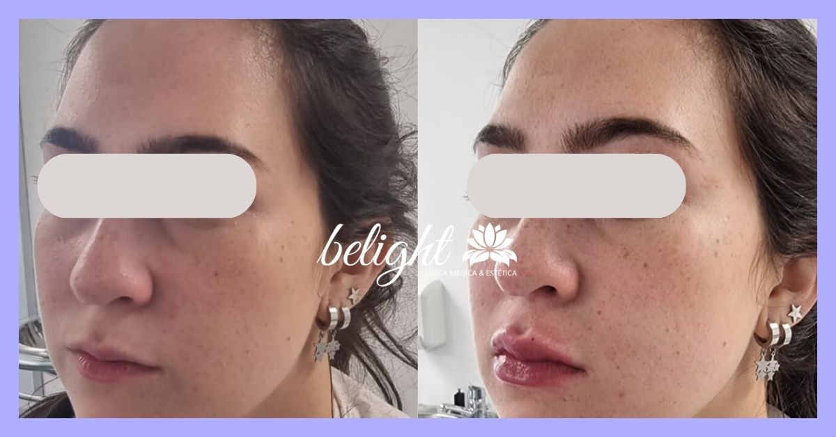 caso 93 antes e depois banner