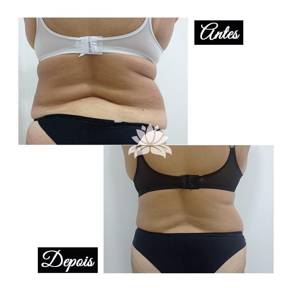 cavitacao antes e depois belight 2