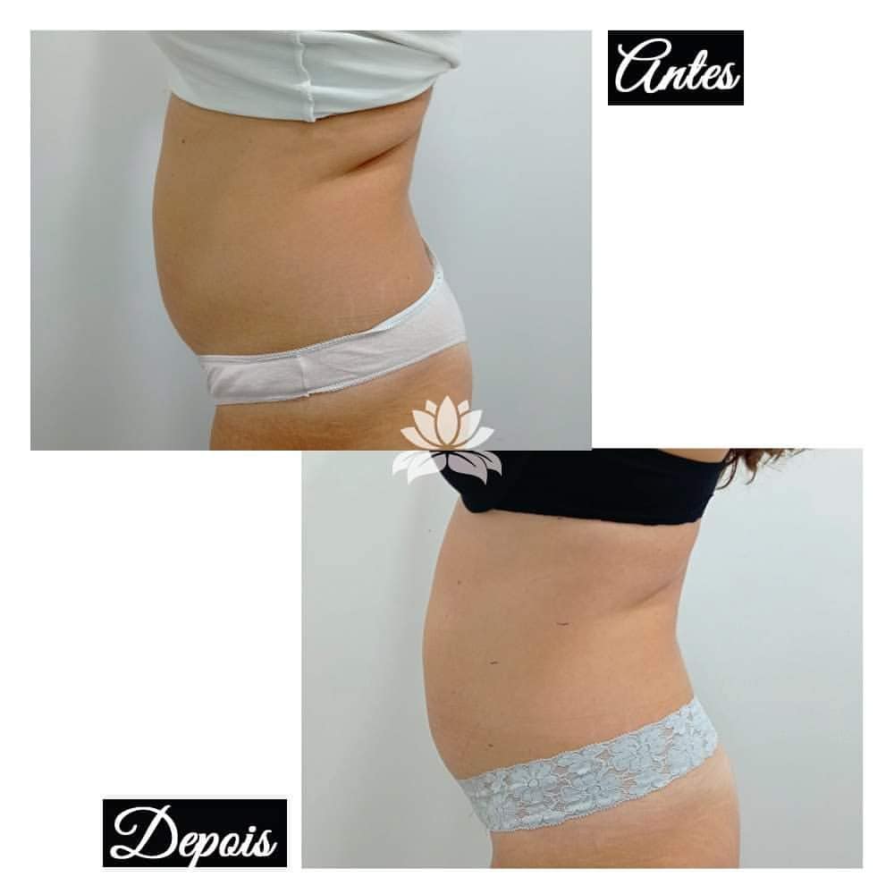 cavitacao antes e depois belight 3