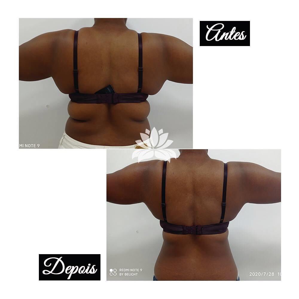 cavitacao antes e depois belight