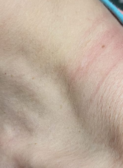 fotos depois de tirar sinais