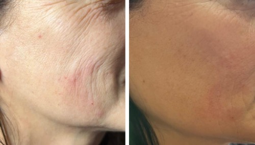 Karisma colagenio injectavel 1