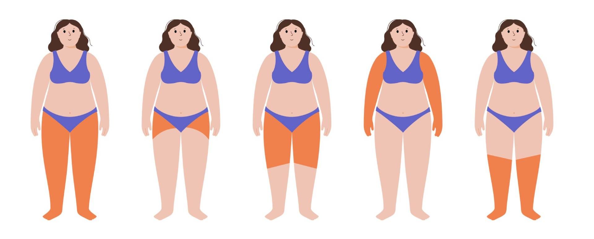 Tipologias de Lipedema