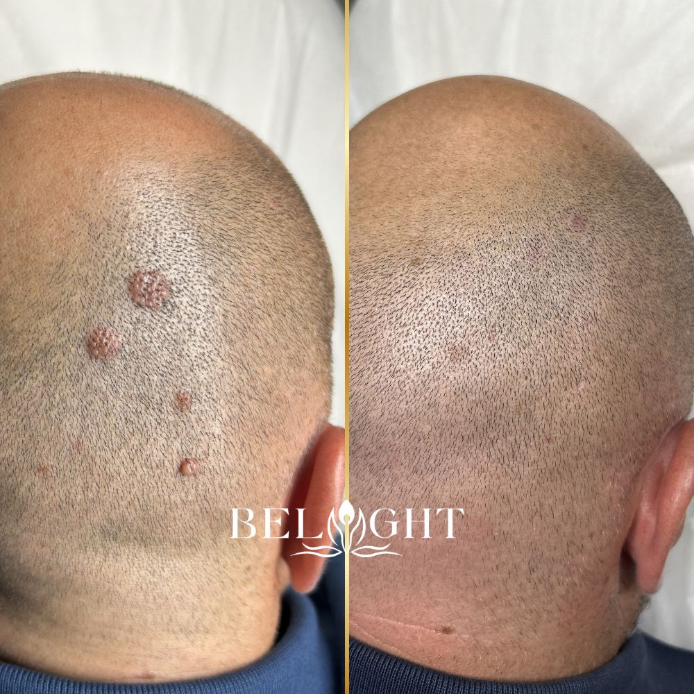 foto antes e depois remoção de sinais e verrugas